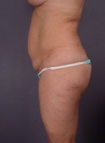 Liposuction Before and after photo