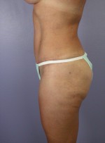 Liposuction Before and after photo