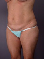 Liposuction Before and after photo