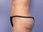 Liposuction Before and after photo