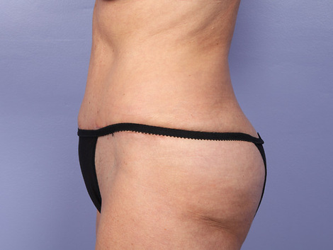 Liposuction before and after photo