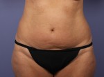 Liposuction