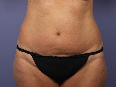 Liposuction before and after photo