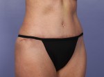 Liposuction