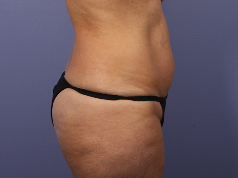 Liposuction before and after photo