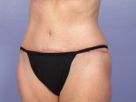 Liposuction Before and after photo