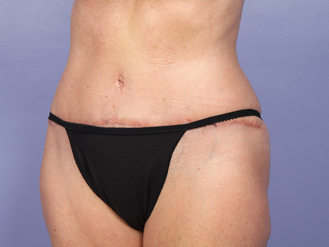 Liposuction before and after photo