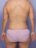 Liposuction Before and after photo