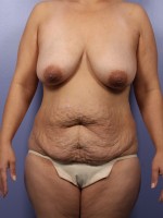 Liposuction Before and after photo