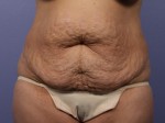 Liposuction Before and after photo