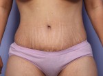 Liposuction Before and after photo