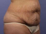 Liposuction Before and after photo