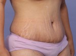 Liposuction Before and after photo