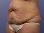 Liposuction Before and after photo