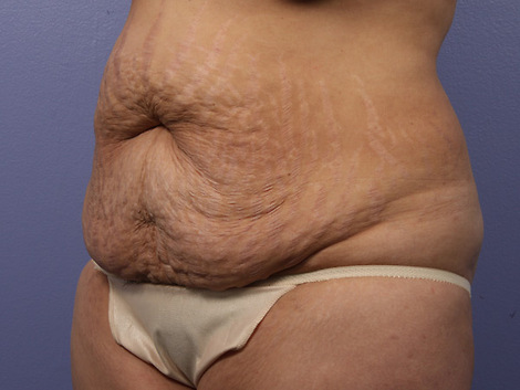 Liposuction before and after photo