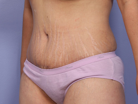 Liposuction before and after photo