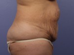 Liposuction Before and after photo