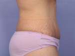 Liposuction Before and after photo