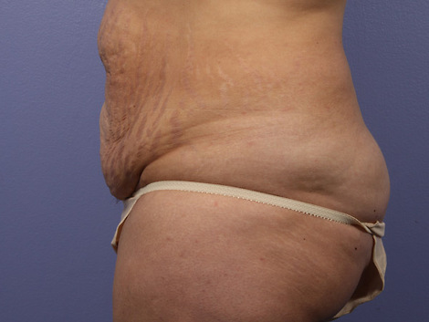 Liposuction before and after photo