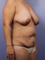 Liposuction Before and after photo