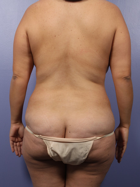 Liposuction before and after photo