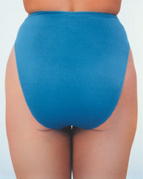 Liposuction before and after photo