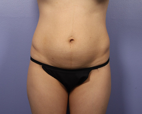 Liposuction before and after photo