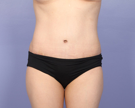 Liposuction before and after photo