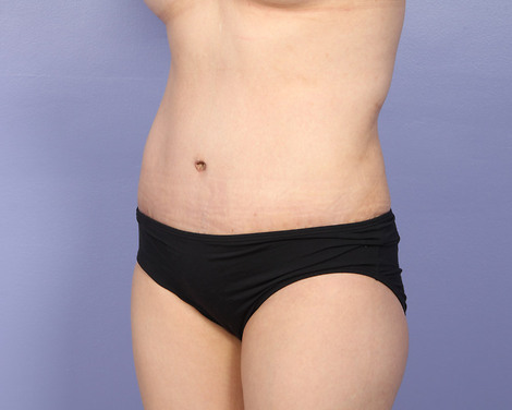 Liposuction before and after photo