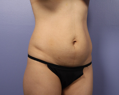 Liposuction before and after photo