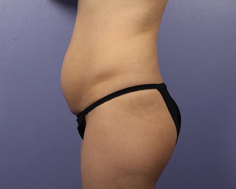 Liposuction before and after photo