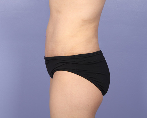 Liposuction before and after photo