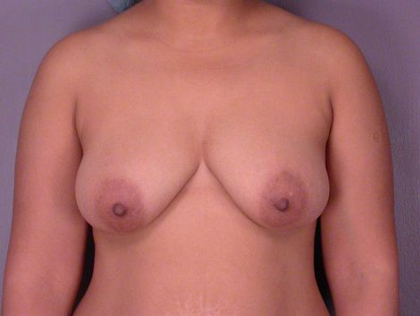 Liposuction before and after photo