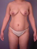 Liposuction Before and after photo