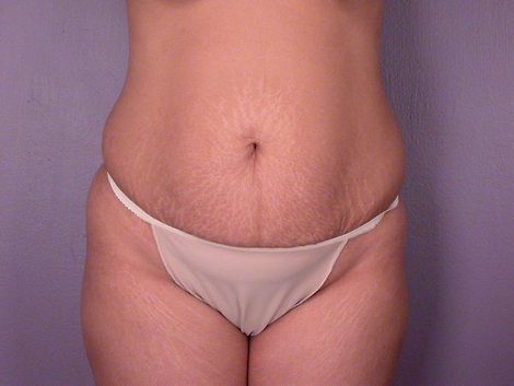 Liposuction before and after photo