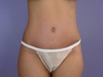 Liposuction Before and after photo