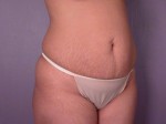 Liposuction Before and after photo