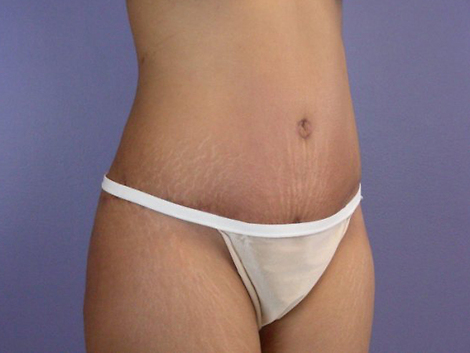 Liposuction before and after photo