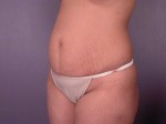 Liposuction Before and after photo