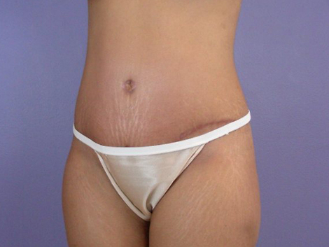 Liposuction before and after photo