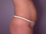 Liposuction Before and after photo