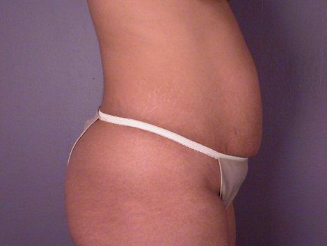 Liposuction before and after photo