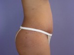 Liposuction Before and after photo