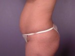 Liposuction Before and after photo