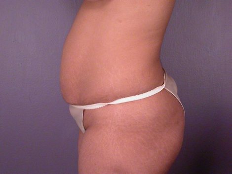 Liposuction before and after photo