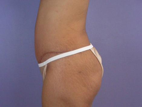 Liposuction before and after photo