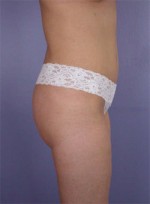 Liposuction Before and after photo