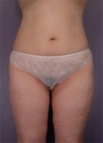 Liposuction