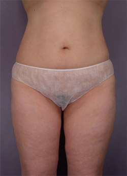 Liposuction before and after photo
