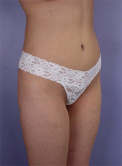 Liposuction before and after photo